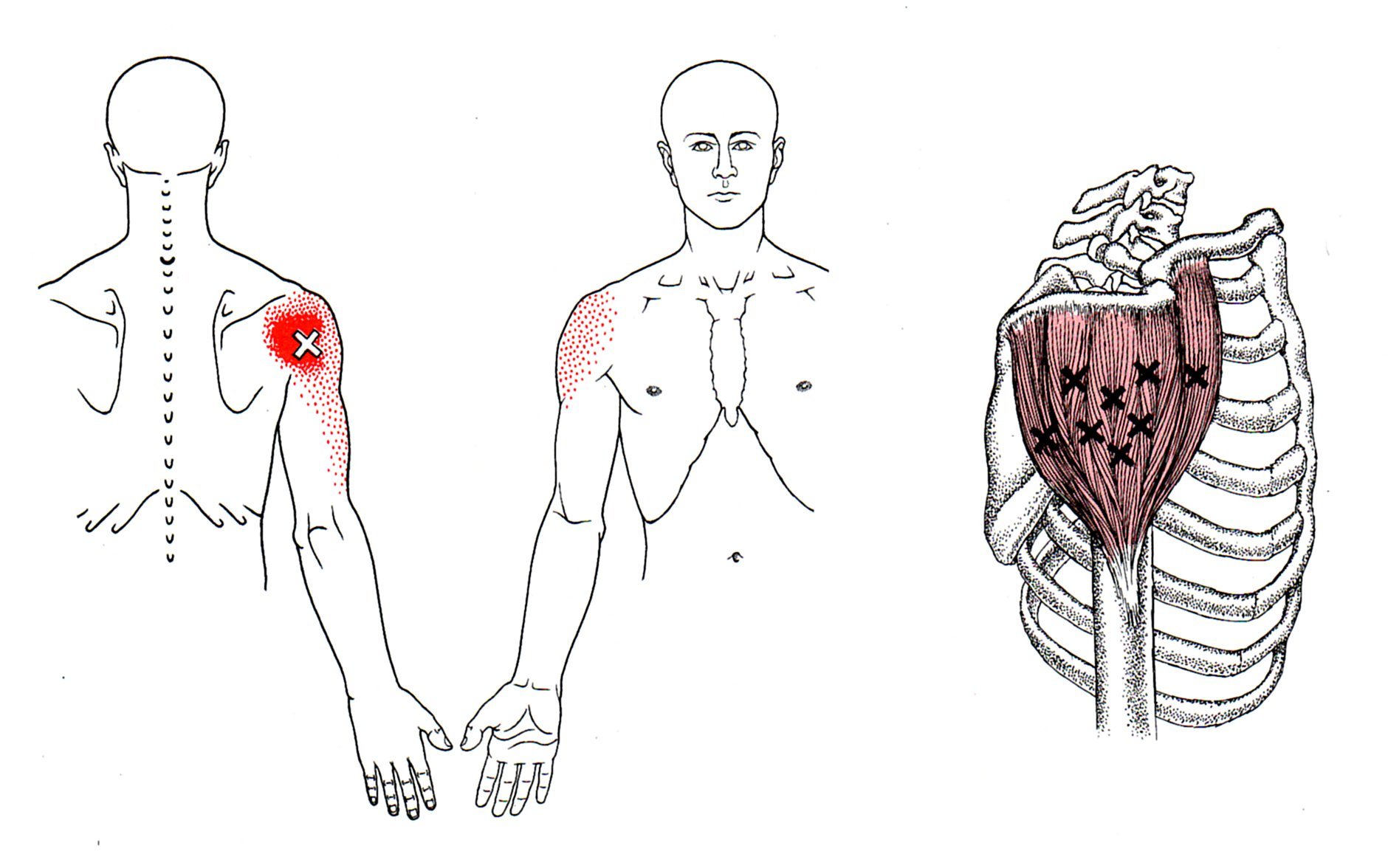 Deltoid The Trigger Point And Referred Pain Guide